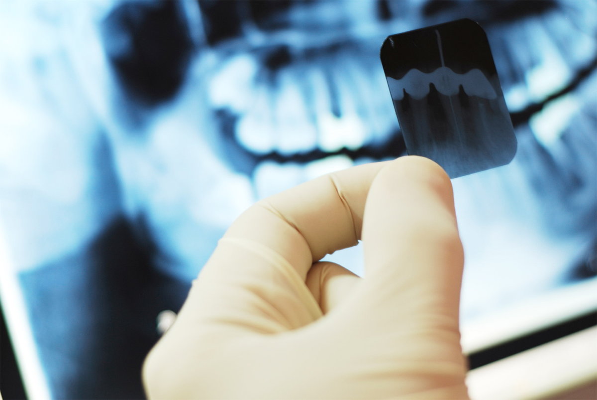 Рентген зуба в Рязани