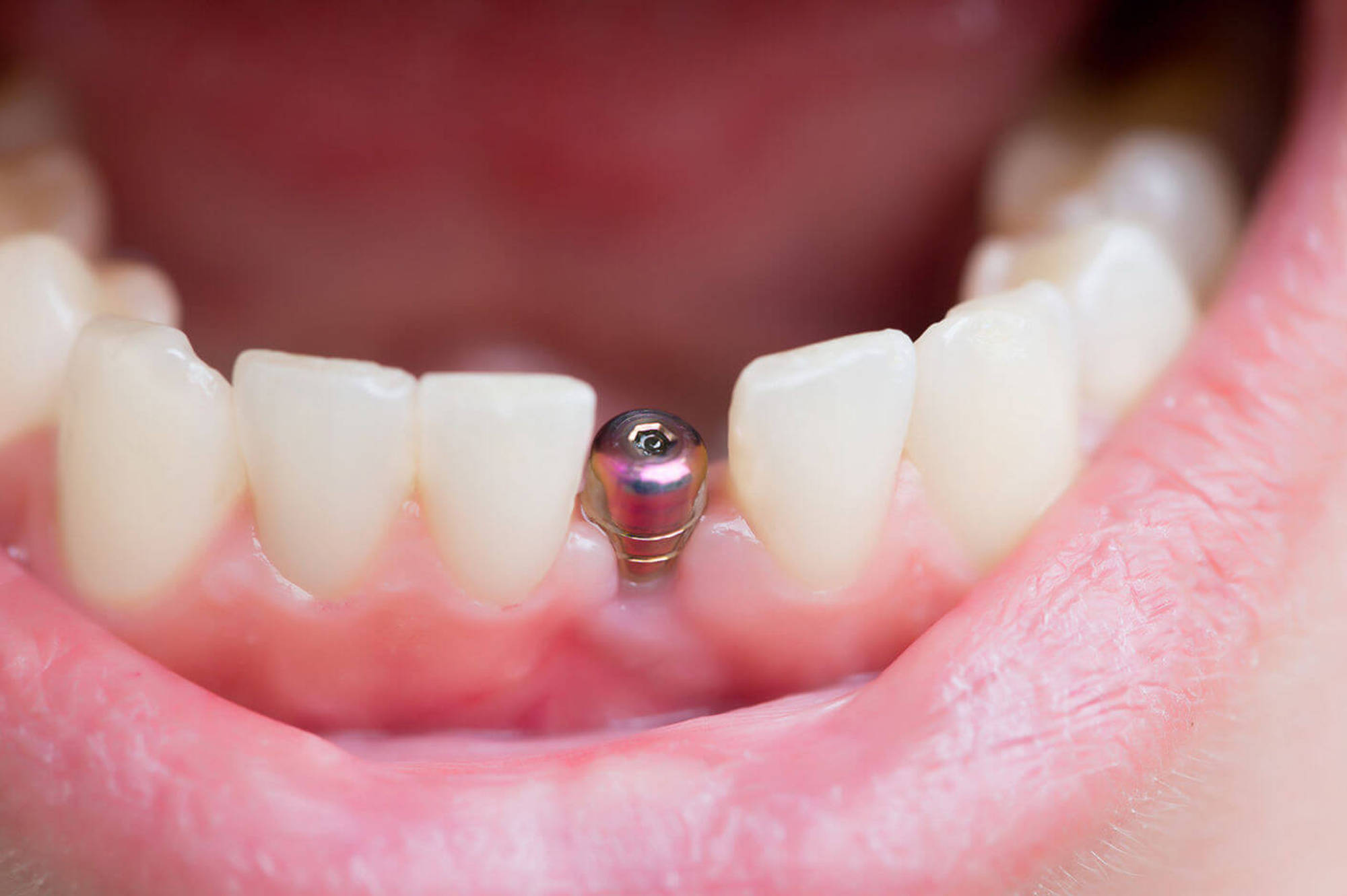 Имплантация зубов в Рязани