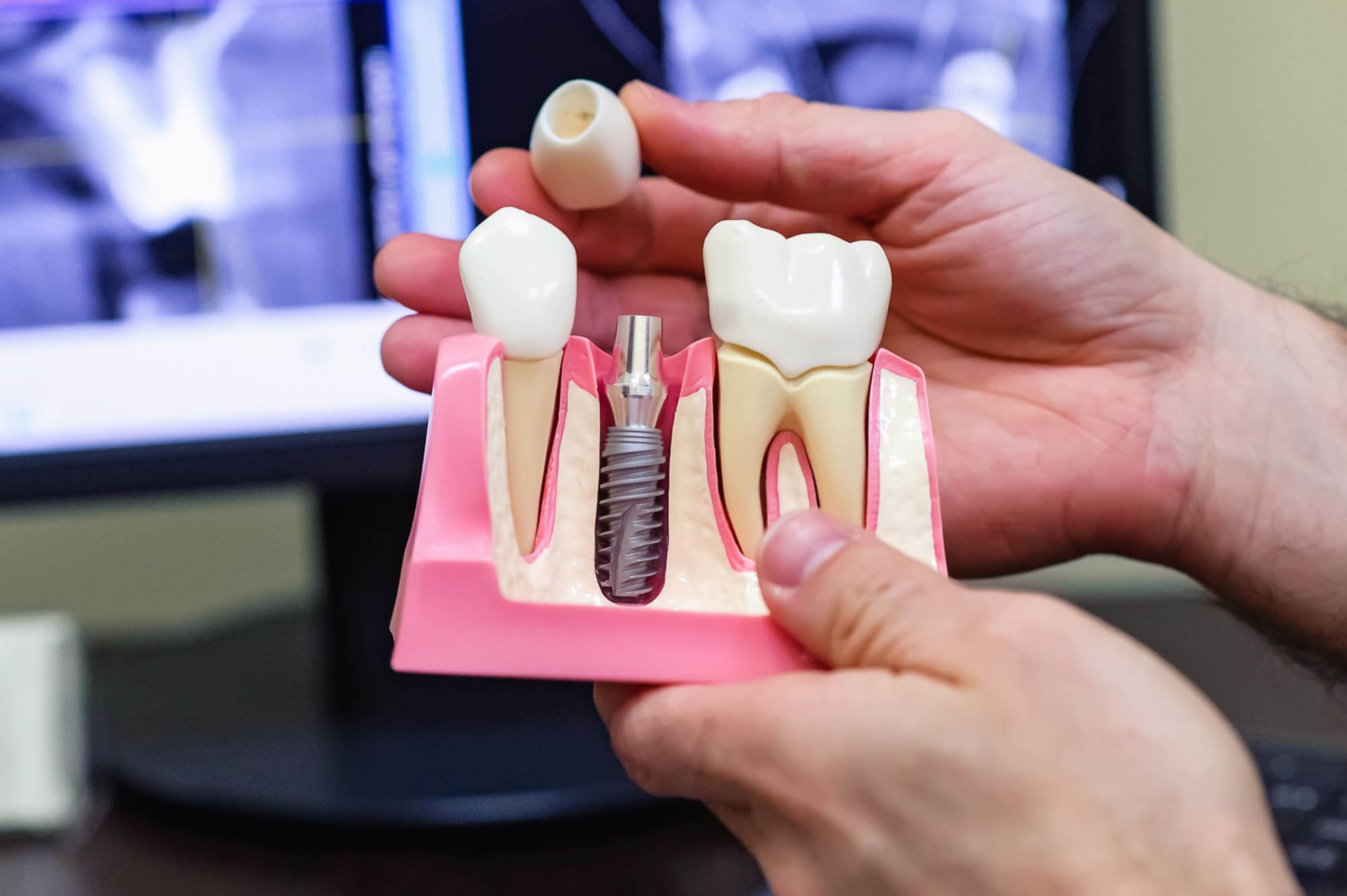 Имплантация зубов премиальными имплантатами Nobel