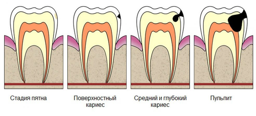 Лечение пульпита молочных зубов – разве такое бывает?