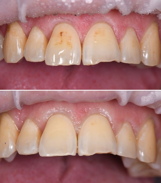 Микроабразия зубов – что это за процедура?