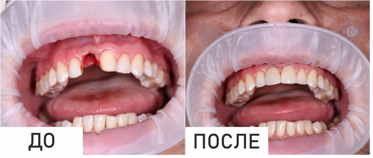 Как можно восстановить потерянный зуб?