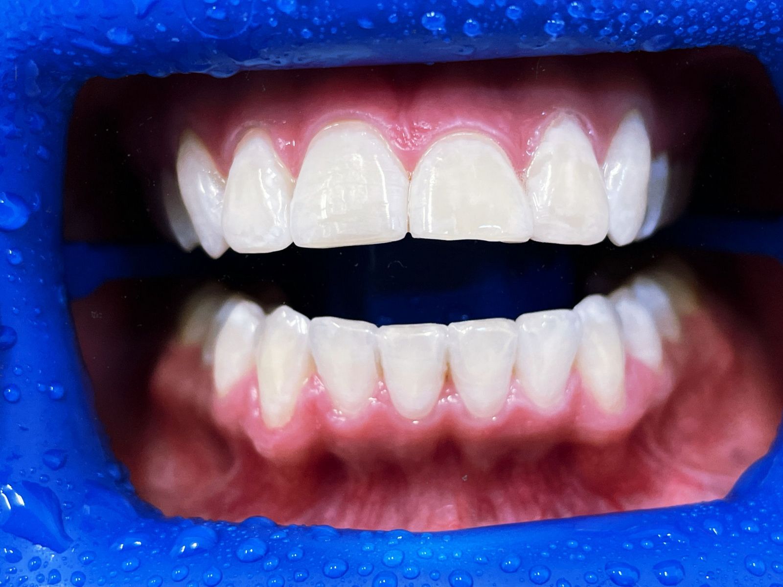Какое отбеливание зубов эффективнее всего?