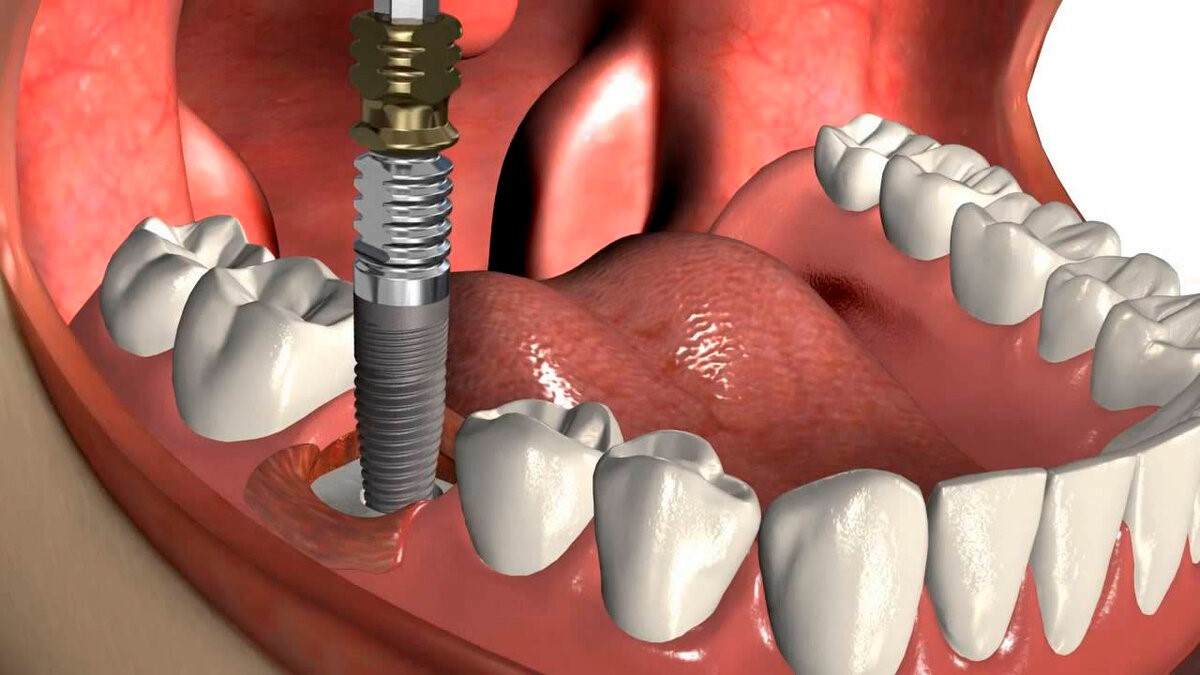 Что делать, если зуб давно удален и нужно сделать имплантацию